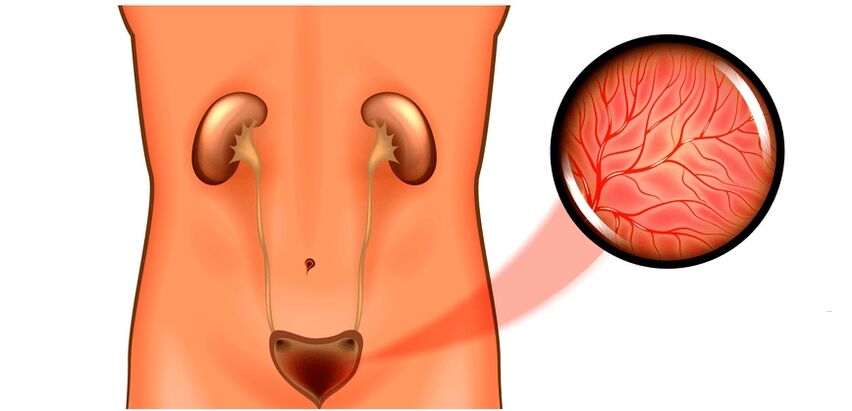 Cystitis in men symptoms and treatment
