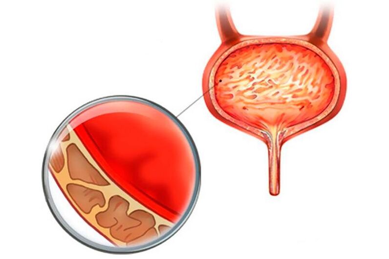 Inflammation of the bladder mucosa with cystitis